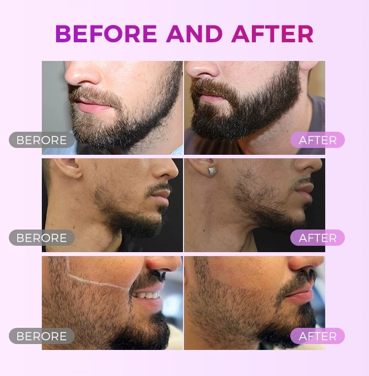Diode Laser Beard Shaping for Men Diode Laser Beard Shaping for Men