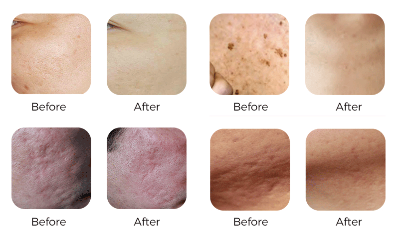 co2 laser fractional portable beauty machine co2 laser fractional portable beauty machine